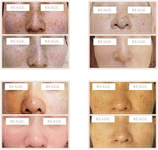 リアージュ（シミケア）30分コース 5回券 リアージュ シミケア フェイシャルコース 30分 5回券 クレンジング 角質ケア マスク ヘッドマッサージ 低周波パルス コース チケット 5回分 セット 