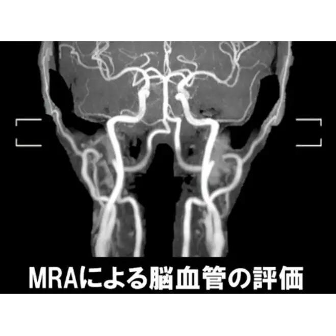 簡易脳ドック受診券1名分 脳ドック 利用 クーポン券 健康診断 チケット 人間ドック 浜松PET診断センター 検診 MR検査 超音波検査 血液検査 静岡 浜松市