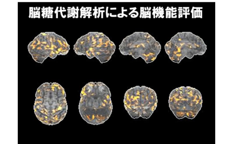 PETがん検診/総合コース+脳オプション受診券1名分 がん PET 脳 利用 クーポン券 健康診断 チケット 人間ドック 浜松PET診断センター 検診 PET CT MRI 超音波 画像診断 MRA検