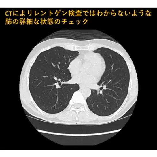 肺がんCT検診受診券1名分 肺がんCT 利用 クーポン券 健康診断 チケット 人間ドック 浜松PET診断センター 検診 CT検査 静岡 浜松市