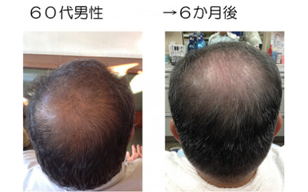 B703 薄毛予防頭皮改善エステ