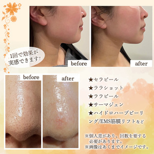 ＜数量限定＞フェイシャルエステ利用券(30,000円分(3,000円×10枚分)/フェイシャルエステプラン全メニューに使用可) ハーブピーリング ララピール ニキビ 小顔リフトアップ 美容 サロン レ