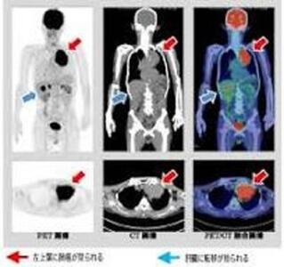 PET/CTドック      がんの早期発見に役立てるドックです