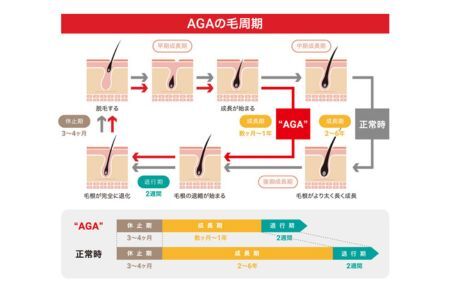 AGAによる薄毛リスクが、髪の毛数本でわかる!【毛髪ホルモン量測定キット(DHT)】