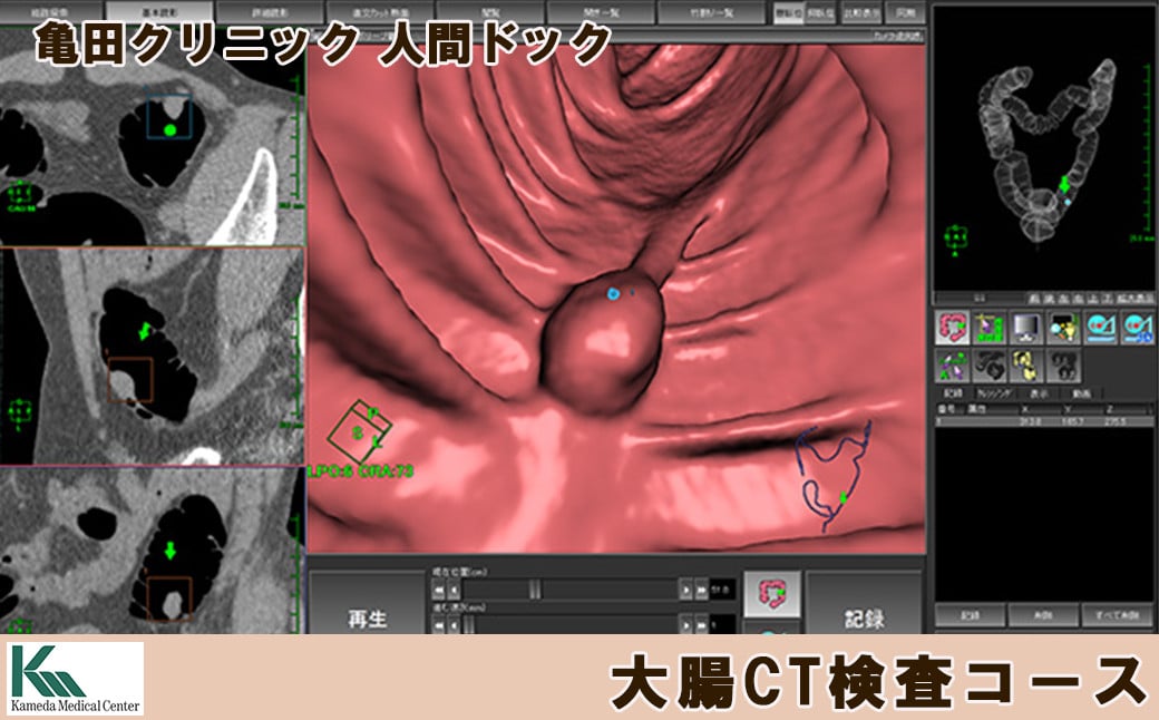 
【亀田クリニック人間ドック】大腸CT検査コース　１名様（単独）　[0130-0001]
