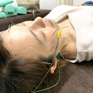 MOHALA鍼灸院美容施術体験チケット（美容鍼等のフェイシャル施術 30分） ※北海道・沖縄・離島への配送不可