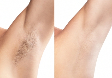 【メンズ脱毛】全身脱毛※VIO全顔付き_FL03