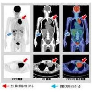 PET/CTドック      がんの早期発見に役立てるドックです