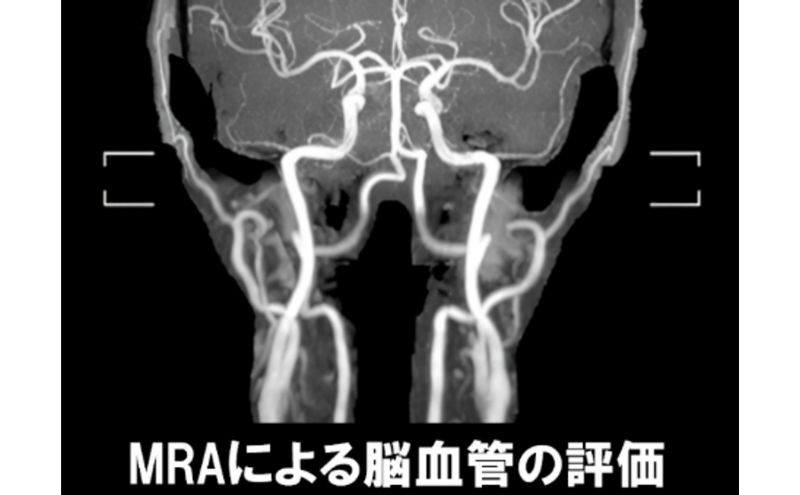 PETがん検診/総合コース+脳オプション受診券1名分 がん PET 脳 利用 クーポン券 健康診断 チケット 人間ドック 浜松PET診断センター 検診 PET CT MRI 超音波 画像診断 MRA検